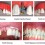 Benefits of Tooth Replacement