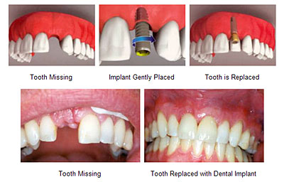 Benefits-of-Tooth-Replacement