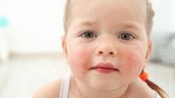 Food Allergy in Children