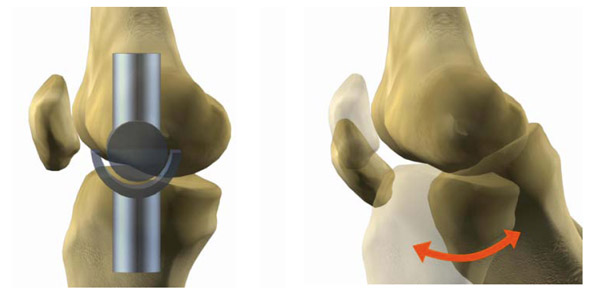 bms-knee-joint