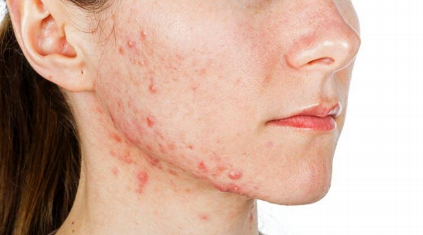 Homeopathy in Acne