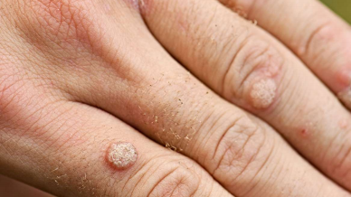 Homeopathy in Warts