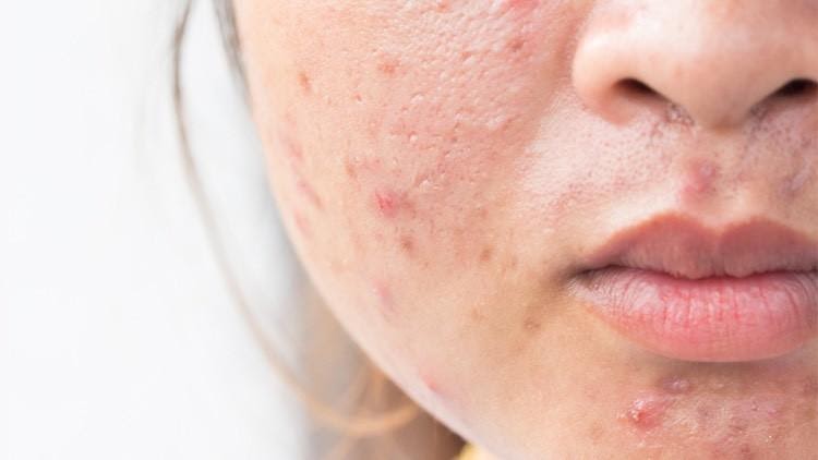 Skin Care 6 Common Acne Myths Busted